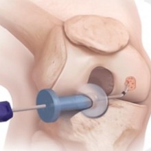 Cientistas aprimoram método para criar cartilagem artificial