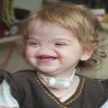 Menina nasce sem nariz e criará prótese por impressora 3D