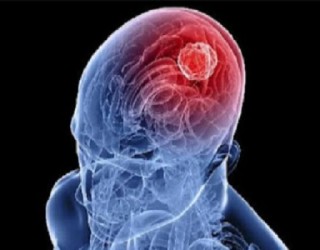 Cisto colóide cerebral - vesícula anormal dentro do cérebro