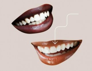 Clareamento Dental: Remova o tártaro e deixa os dentes mais brancos!