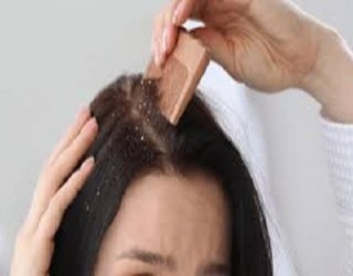 4 métodos para acabar com sua caspa naturalmente