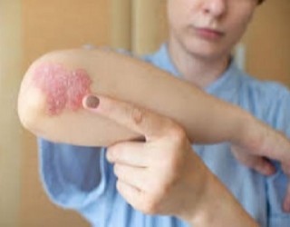 Mastocitose cutânea difusa - alergias e lesões de pele