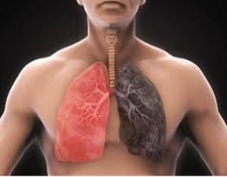 DPOC - doença pulmonar obstrutiva crônica