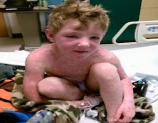Menino é mais uma vítima da síndrome de Stevens Johnson