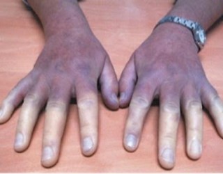 7 sinais da terrível e enigmática síndrome de Raynaud