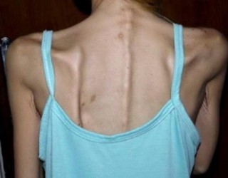 Britânica com anorexia nervosa chegou a pesar 31 kg