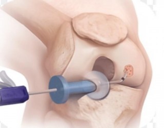 Cientistas aprimoram método para criar cartilagem artificial