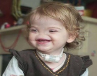 Menina nasce sem nariz e criará prótese por impressora 3D