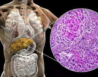 Gordura no fígado: 5 hábitos simples para evitar a condição