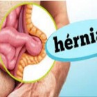 Hérnias - os 5 tipos mais comuns e seus sintomas