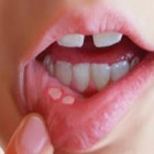 Estomatite - doença que se manifesta na boca
