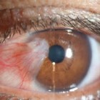 Pterígeo - doença que recobre o branco dos olhos