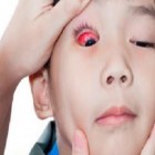 Tracoma - doença infecciosa que afeta a córnea