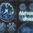 Novo estudo identifica fator-chave para desenvolvimento do Alzheimer