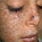 Xeroderma pigmentoso - doença genética da pele