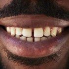 Uma droga para regenerar os dentes pode estar disponível na próxima década