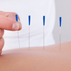Conheça essas 4 curiosidades sobre a acupuntura
