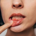 Hipótese liga a peste bubônica à saúde bucal moderna