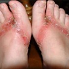 Dermatite de contato - irritação na pele por contato com substâncias