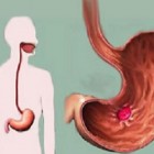 Úlcera nervosa - erosão no epitélio da mucosa gástrica