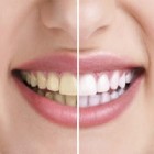 Mitos e verdades sobre o clareamento artificial dos dentes