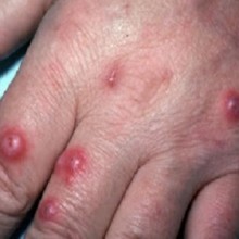 Criptococose - doença infecciosa causada por fungo