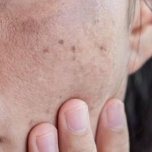 Como evitar e tratar manchas na pele
