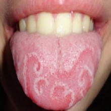 Glossite - faz com que a língua inche e mude de cor