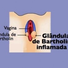 Cisto de Bartholin: causas, sintomas e tratamento