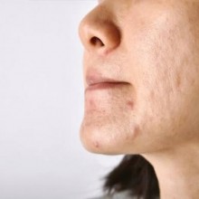 Como reduzir manchas de acne