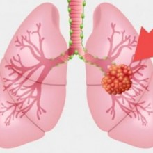 Nódulo no pulmão: o que significa e quando pode ser câncer