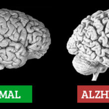 Sintomas de Alzheimer – Tua saúde