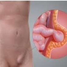 Hérnia inguinal - protusão de parte do intestino para a virilha