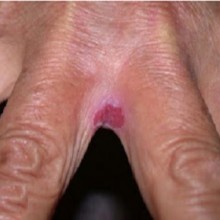Intertrigo candidisíaco - doença da pele que ocorre nas áreas cutâneas