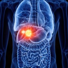 Câncer de fígado: alertas, sintomas e tratamento