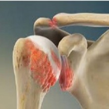 Artrite e osteoartrite - sintomas que você desconhece