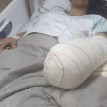 Mulher entra em hospital para ter bebê e acaba saindo com mão amputada