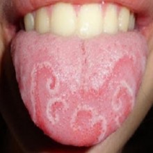 Conheça 9 doenças que se manifestam pela boca