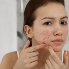 Dicas de como combater a acne