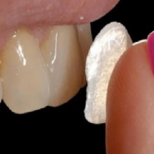 Lente de contato dental - quais as vantagens e restrições deste procedimento?